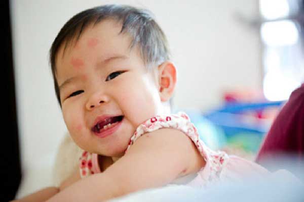 Kem Sudocrem có thể dùng cho vết côn trùng cắn